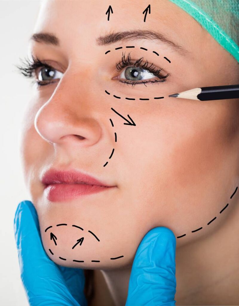 Preenchimento Ácido Hialurônico